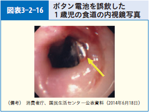 図表3-2-16 ボタン電池を誤飲した１歳児の食道の内視鏡写真