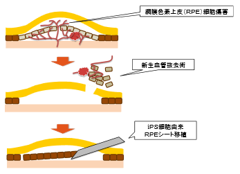 移植手術の方法