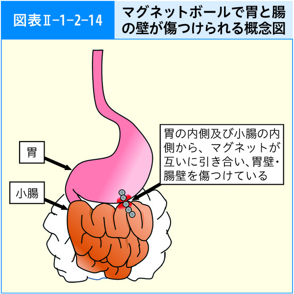 図表Ⅱ-1-2-14　マグネットボールで胃と腸の壁が傷つけられる概念図