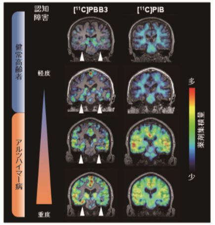 図 7-7　アルツハイマー病の発症と進行に伴う異常タンパク質の脳への蓄積の変化